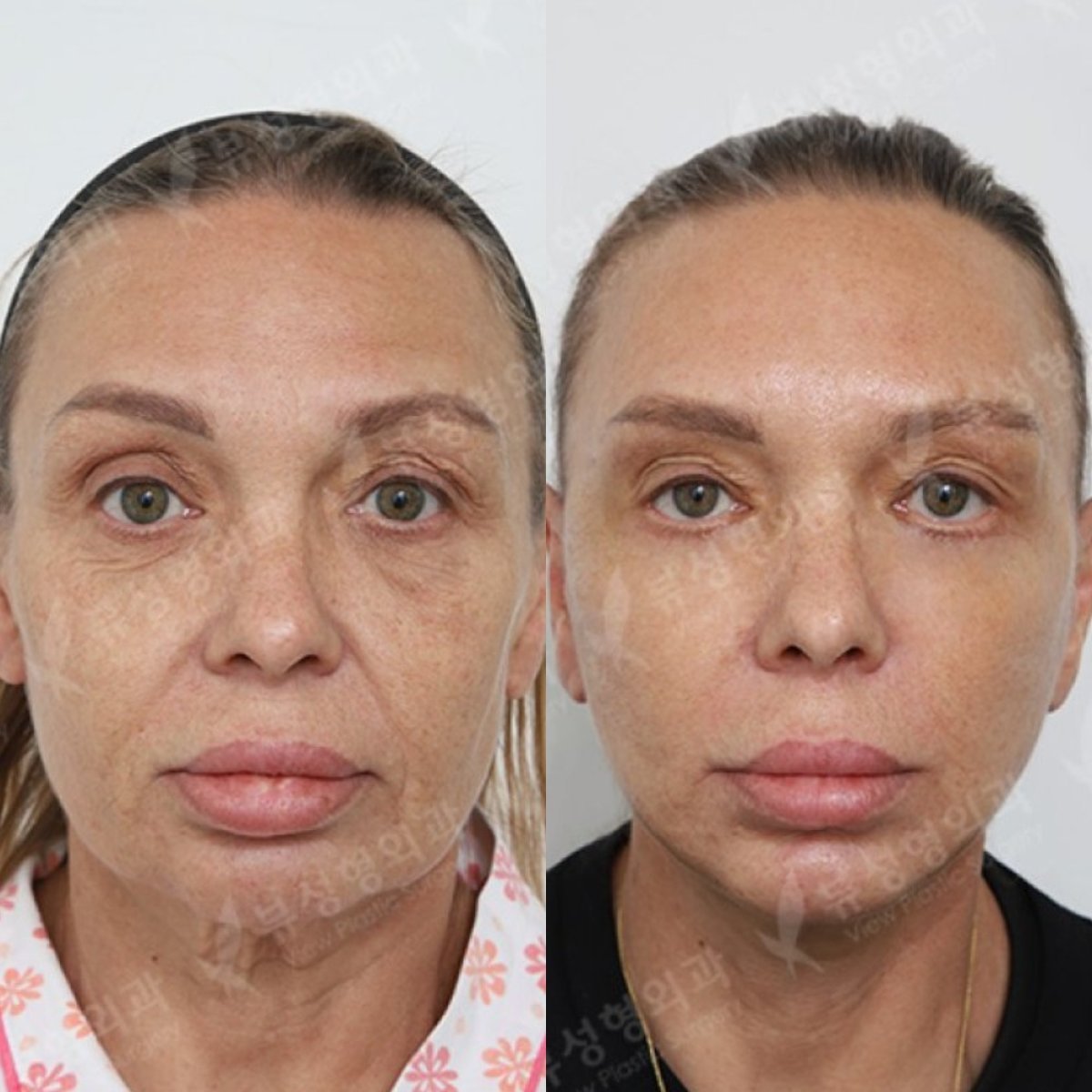 Before and after blepharoplasty results at View Plastic Surgery Hospital, eyelid correction