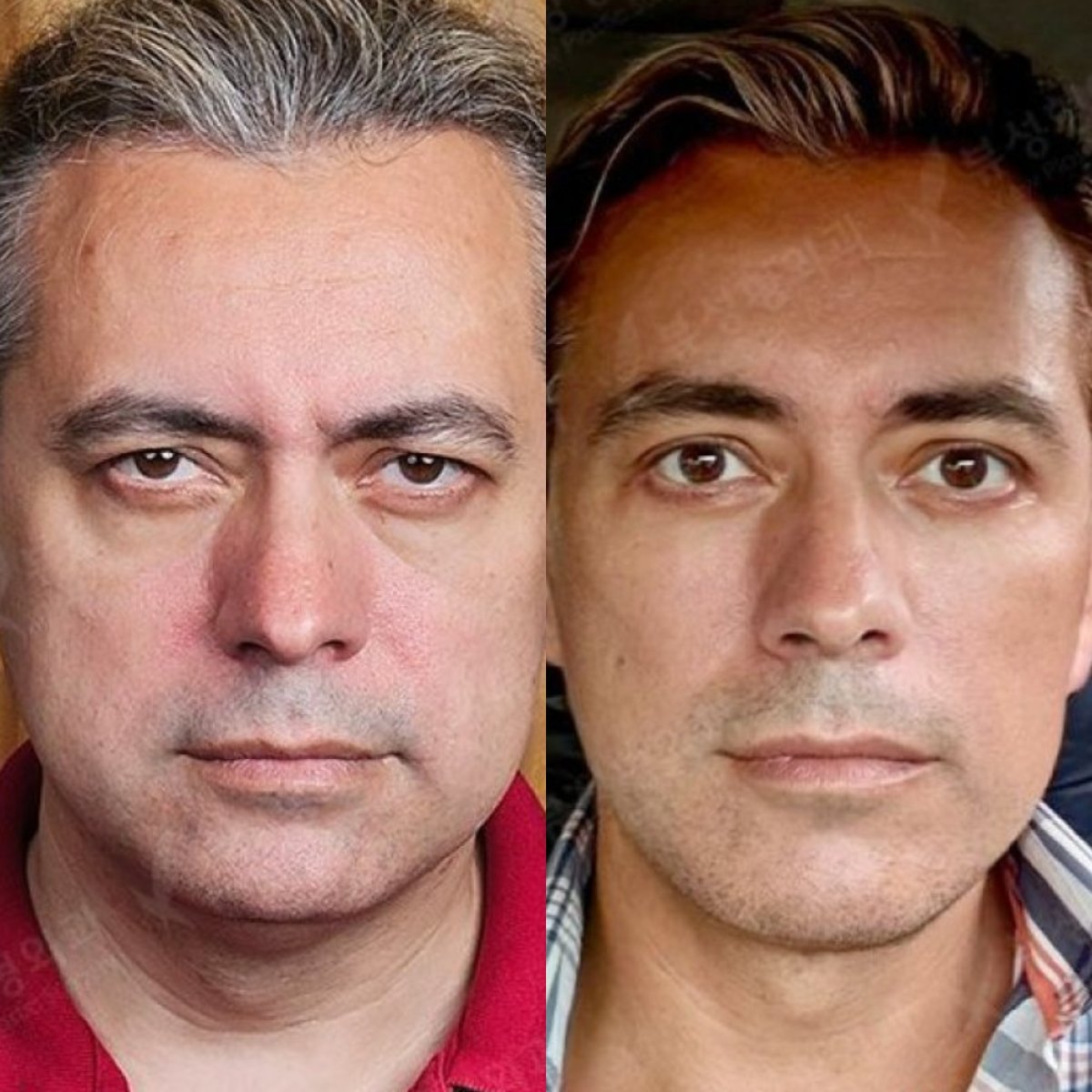 نتائج رأب الجفن قبل وبعد في مستشفى View Plastic Surgery Hospital، تصحيح الجفون