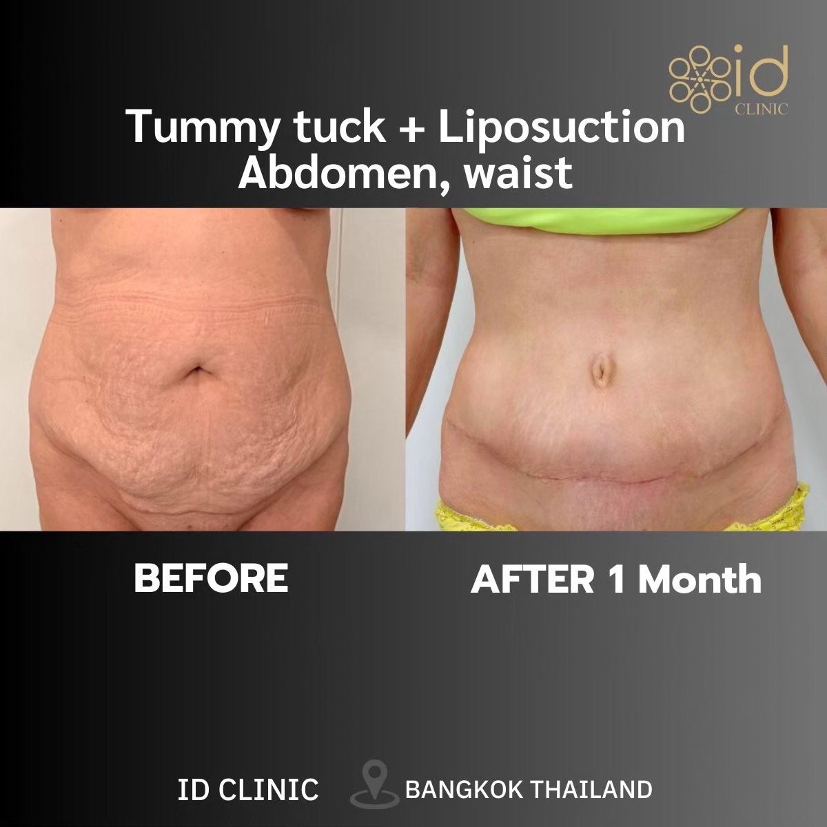Résultats avant/après abdominoplastie avec liposuccion à ID Clinic Bangkok, contour abdominal