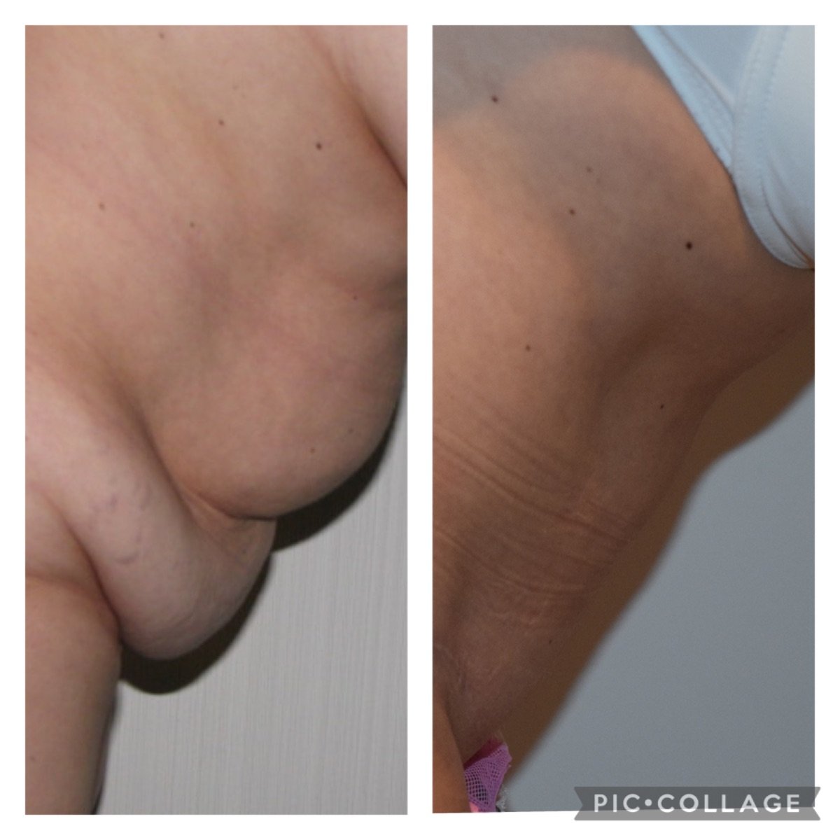 Resultados de liposucción 360 antes y después en Clinica Granado Tiagonce, mejor contorno corporal