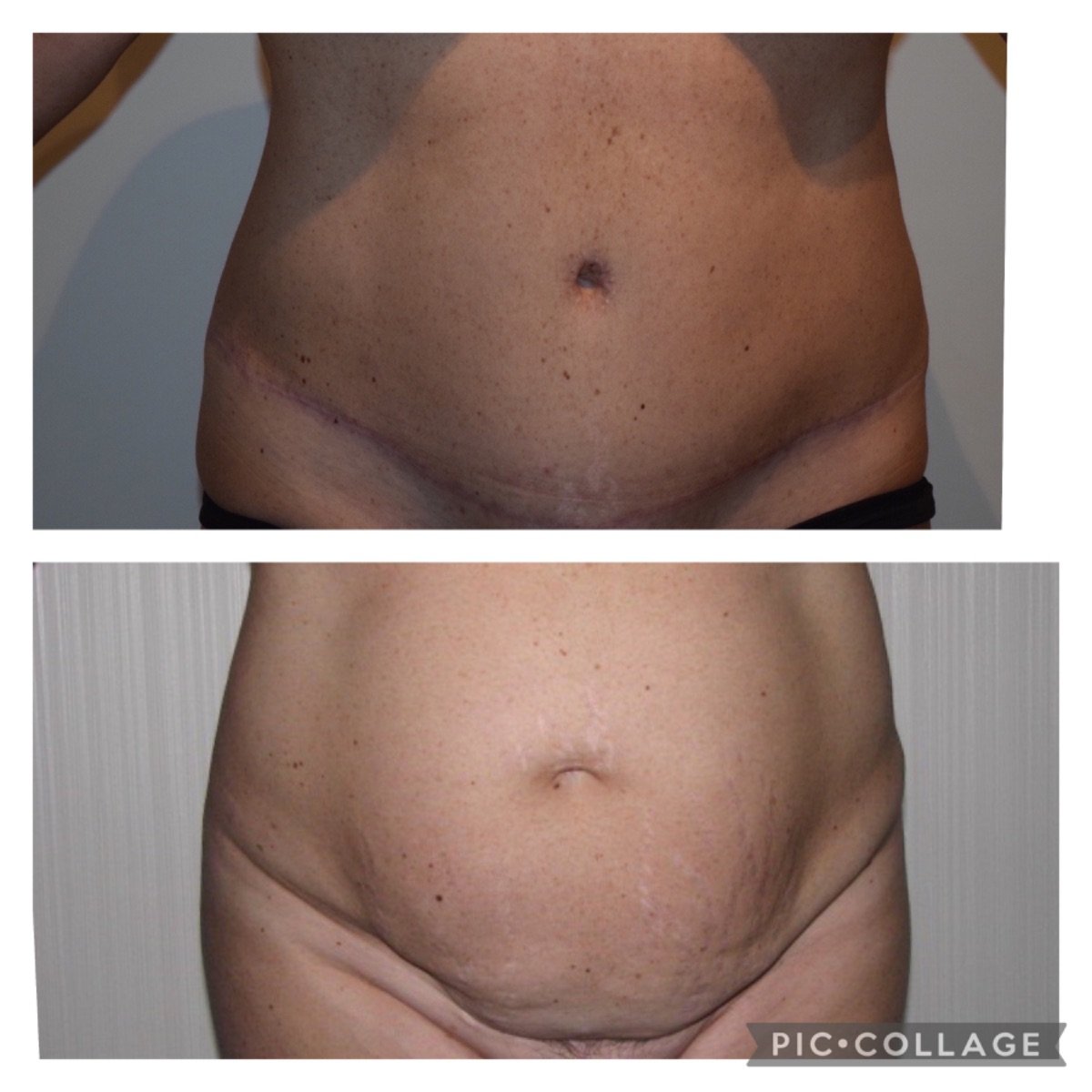 Resultados de liposucción 360 antes y después en Clinica Granado Tiagonce, mejor contorno abdominal