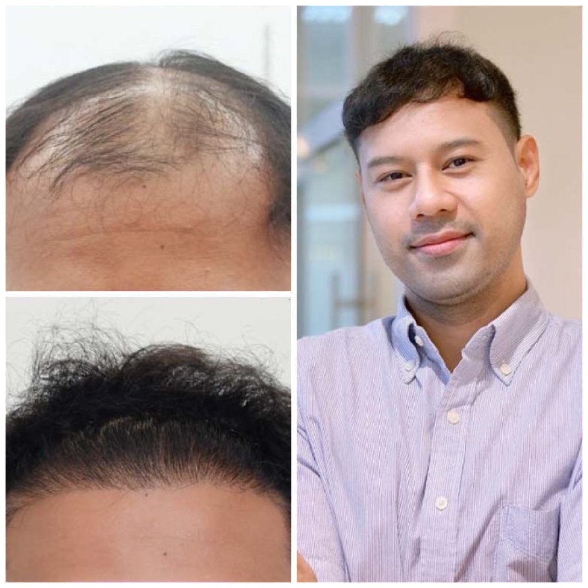 نتائج زراعة الشعر قبل وبعد في قسم الجلدية والجراحة - مستشفى نافامين9