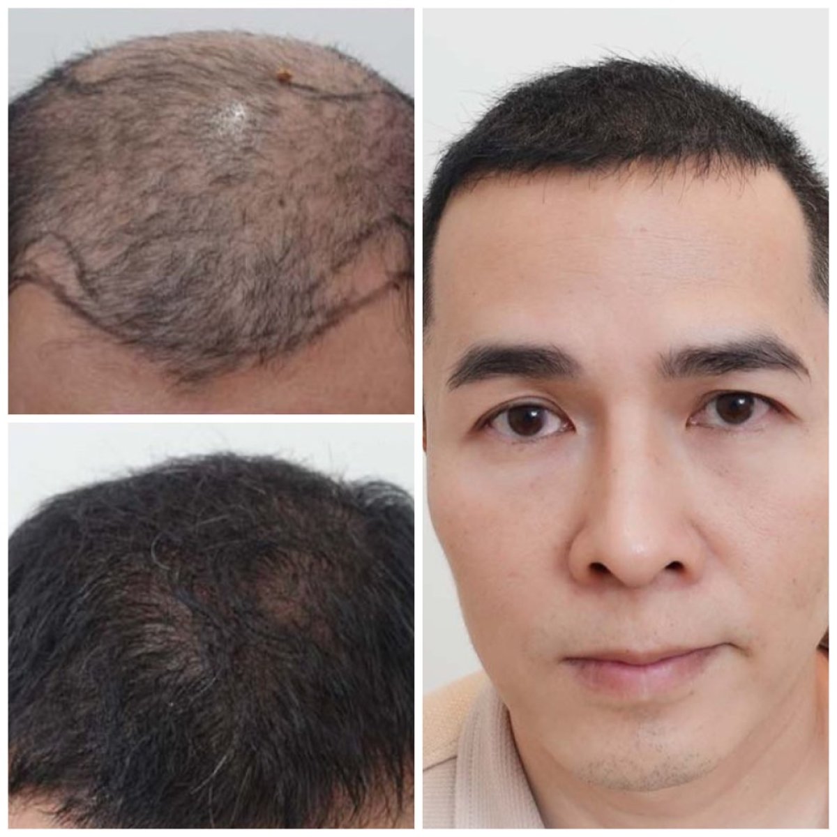 Before and after hair transplant results at Department of Skin & Surgery - NAVAMIN9 HOSPITAL