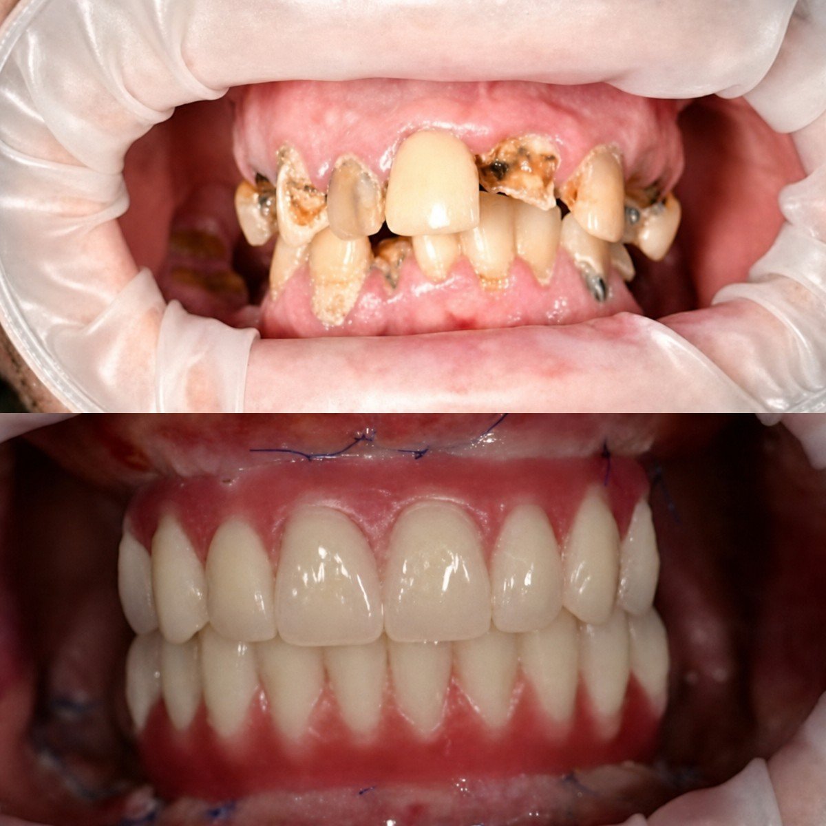 Before and after All-on-6 dental implants at RIKOTA Dental Clinic, full smile restoration result