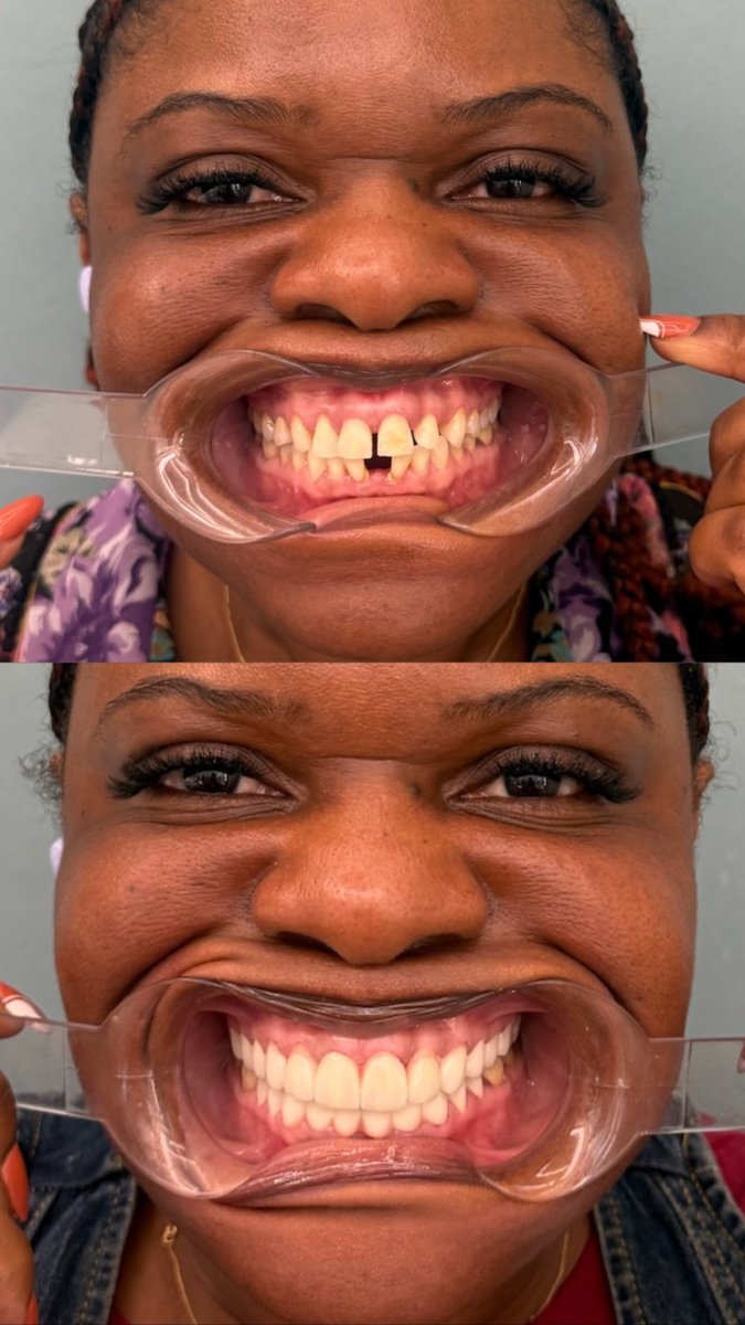 Resultados antes y después de implantes dentales en KLİNİKEN: sonrisa restaurada y dientes alineados