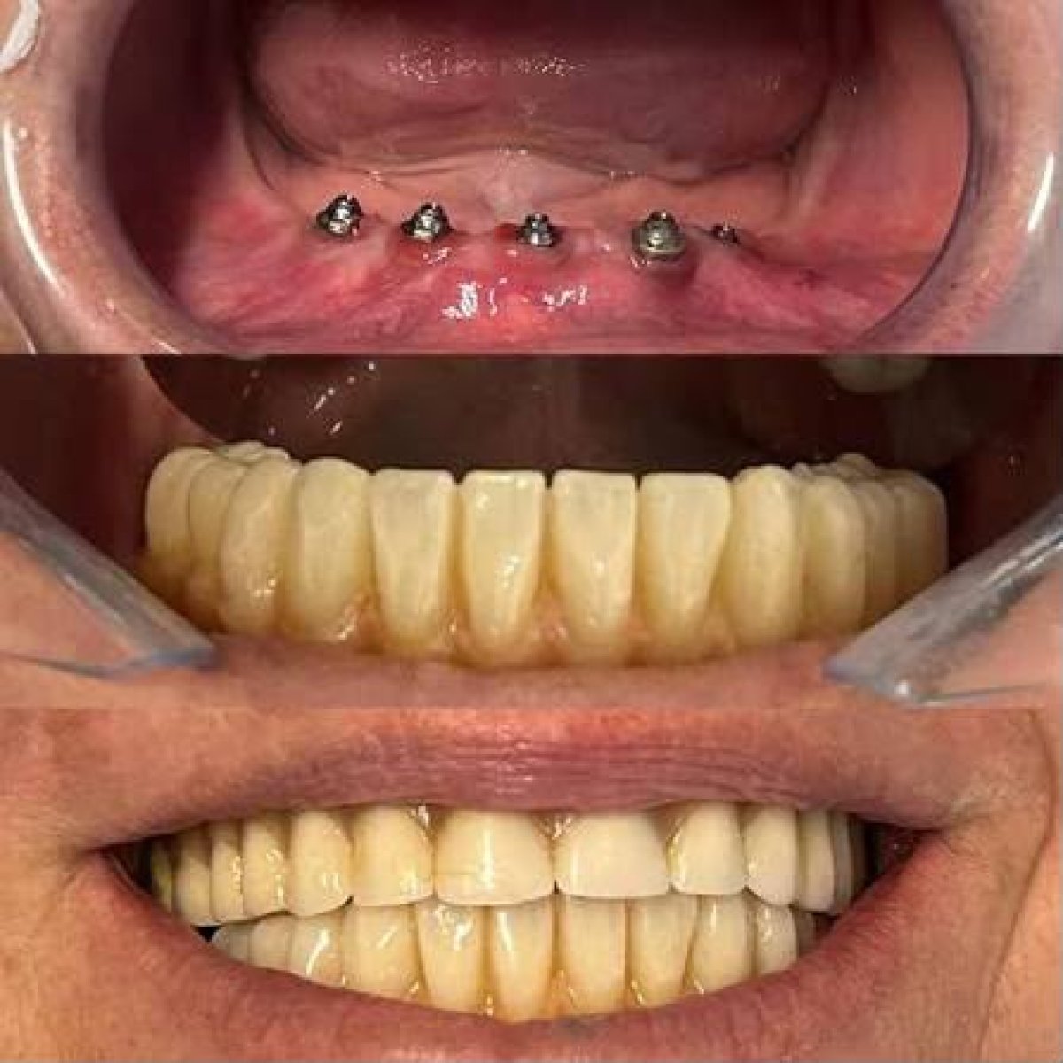 Результаты до и после имплантации зубов в Punta cana dentist odontologia familiar, восстановленная улыбка