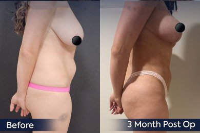 Brazilian Butt Lift Package - photo 4