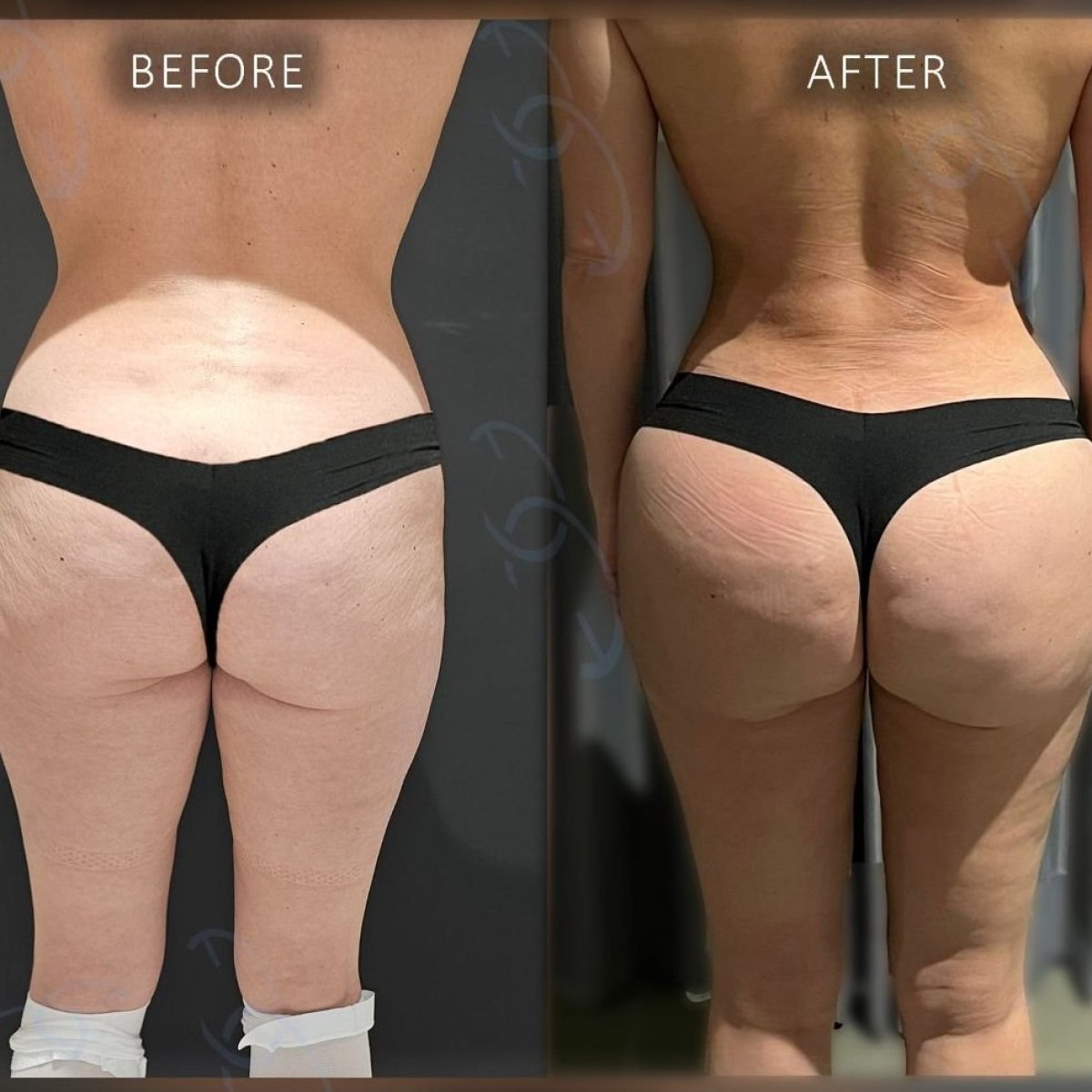 Resultados antes y después de Brazilian Butt Lift en Dr. Safa Manav Clinic, contorno mejorado
