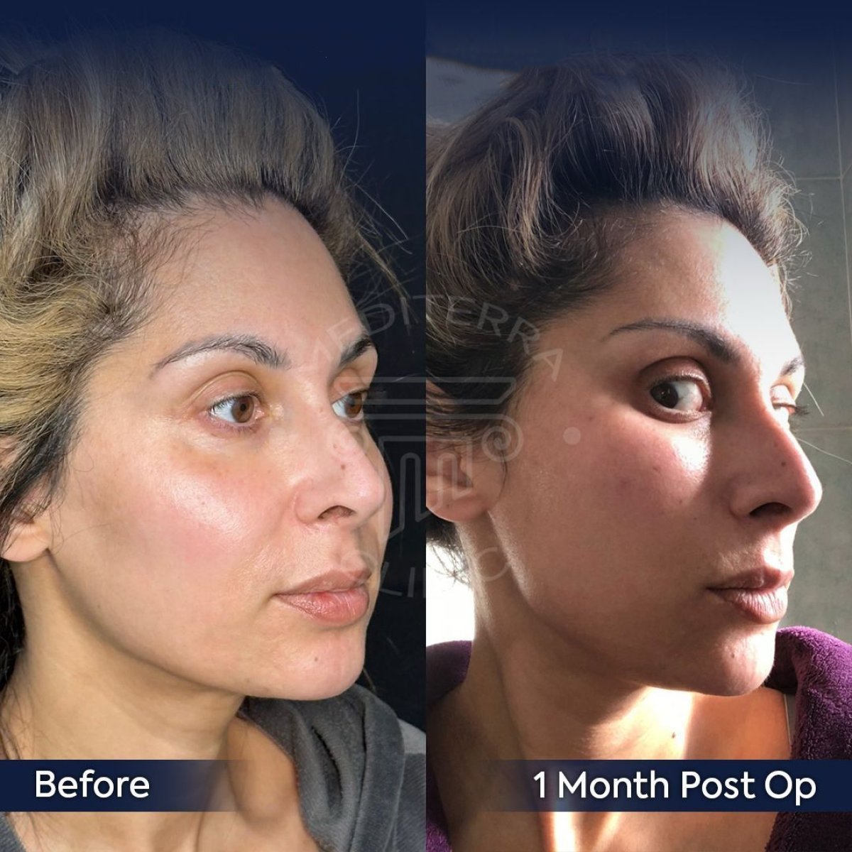 Before and after endoscopic facelift results at Dr. Safa Manav Clinic, visible facial lift