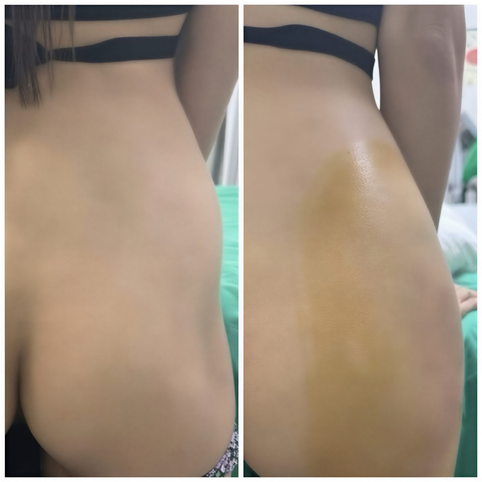 Before and after Brazilian Butt Lift results at Somchai Clinic, enhanced buttock contour