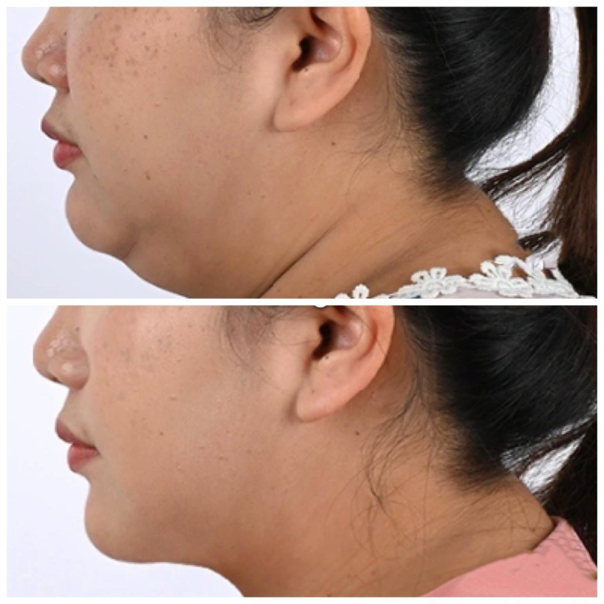 Résultats avant/après liposuccion du cou à la Somchai Clinic, contour du menton amélioré