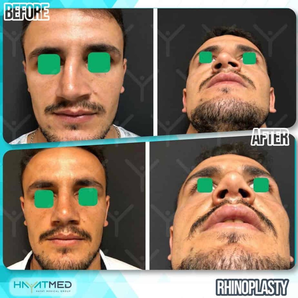 Resultados de rinoplastia antes y después en HayatMed Clinic, mejor forma y simetría nasal