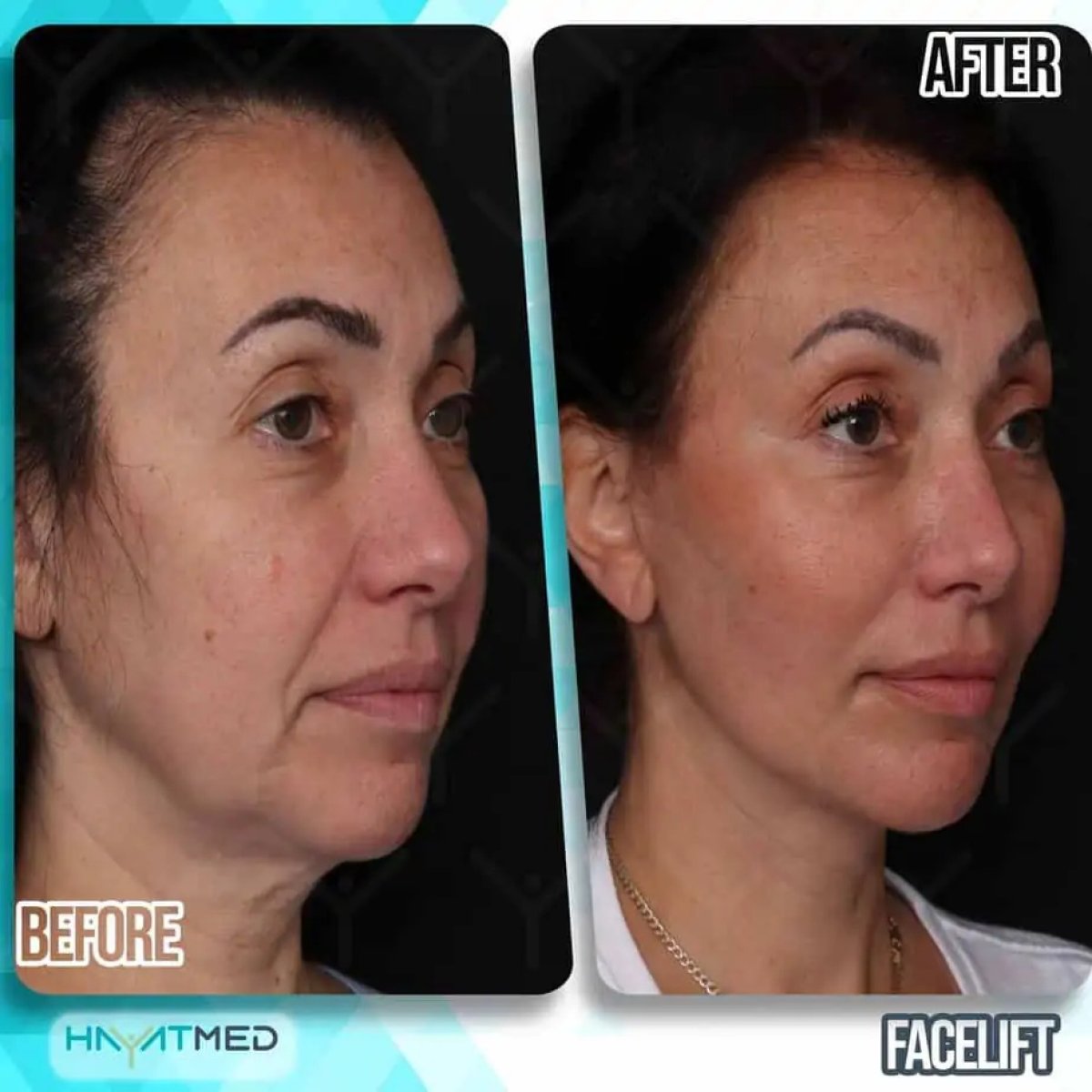 Résultats avant et après lifting du visage à la clinique HayatMed, rajeunissement visible