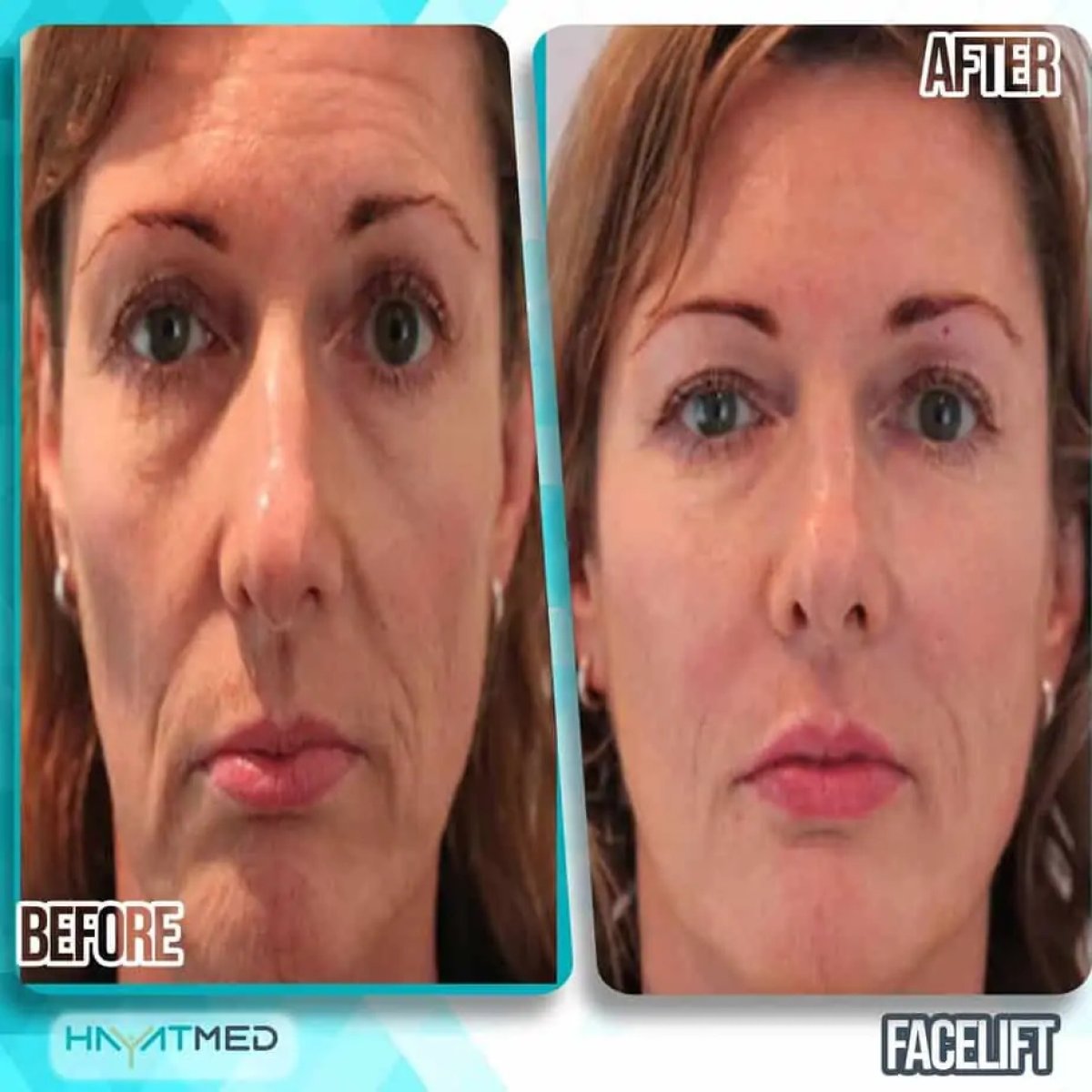 Résultats avant et après lifting du visage à HayatMed Clinic – rajeunissement visible