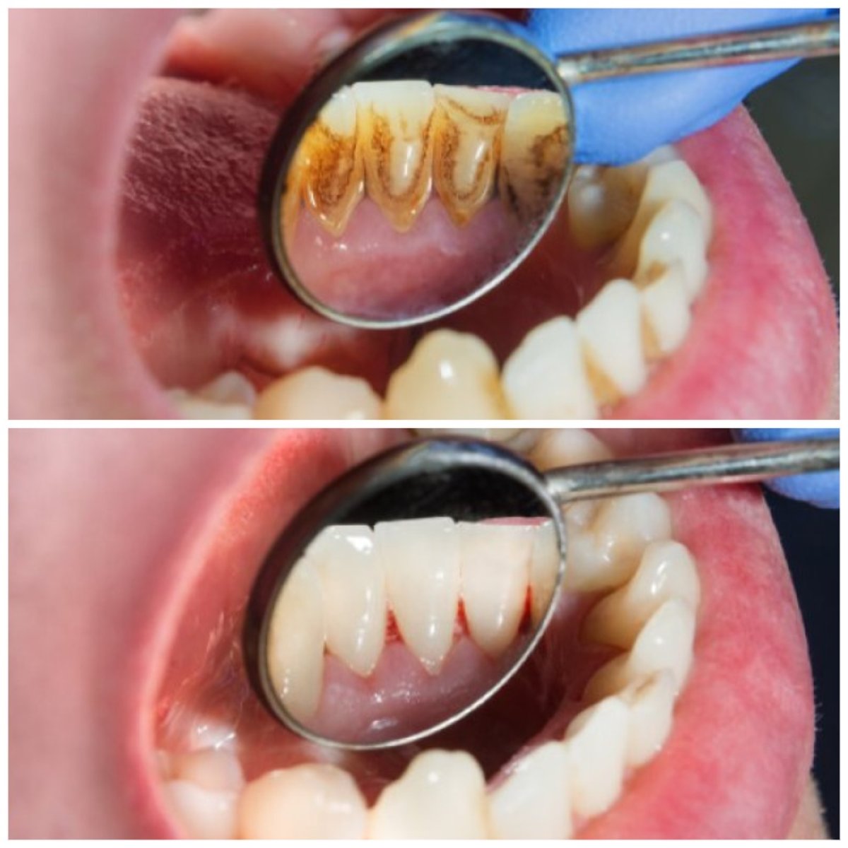 Результат до и после глубокой чистки зубов в ClinicHI Dental Health Center Istanbul
