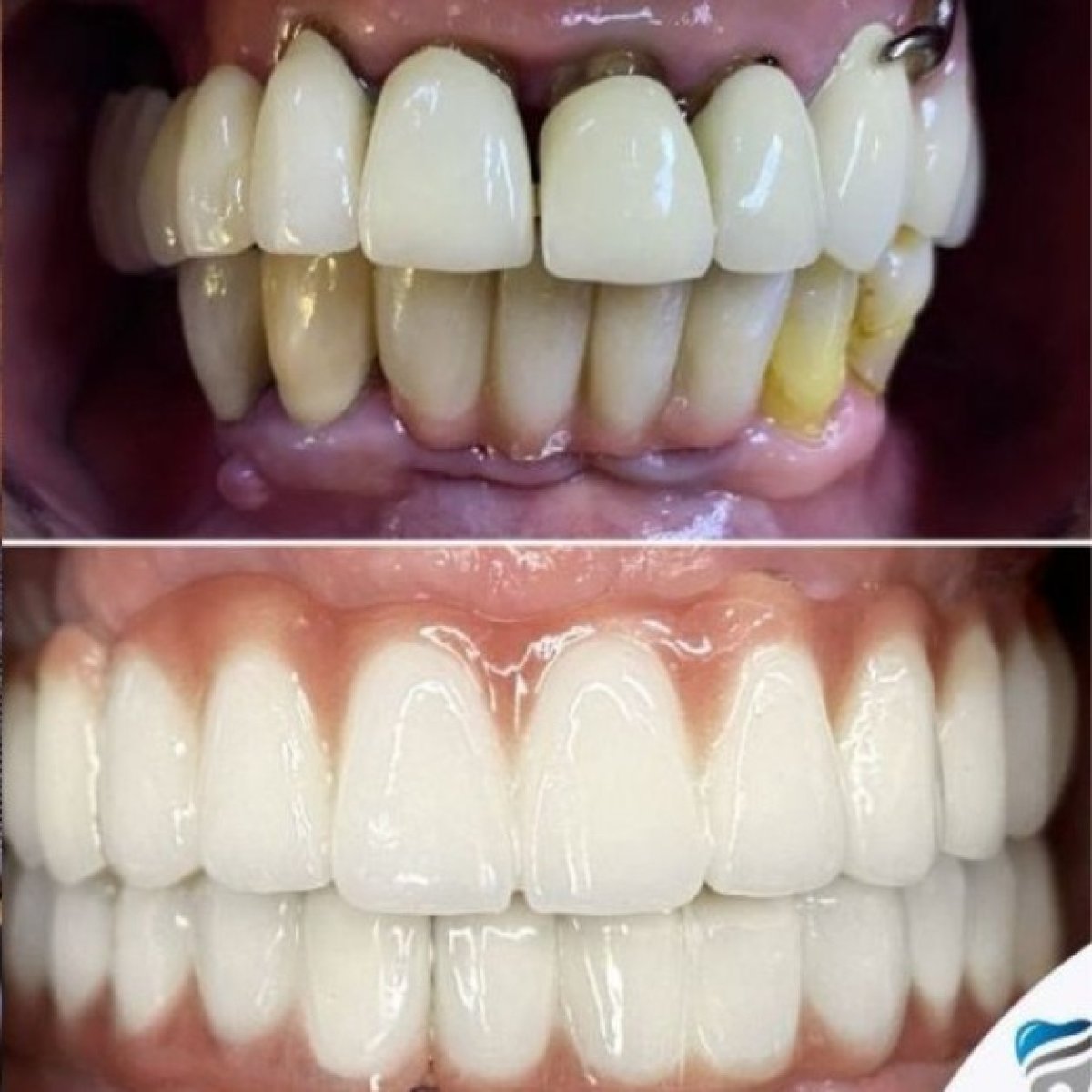 Résultat avant et après implants All-on-4 à ClinicHI Dental Health Center Istanbul