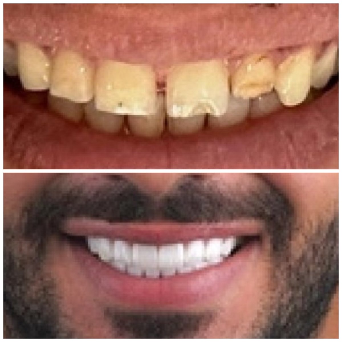 Porcelain veneer before and after results at ClinicHI Dental Health Center Istanbul, smile makeover