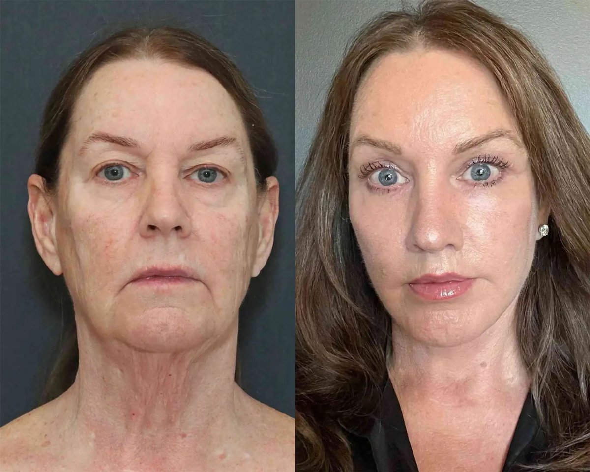Before and after facelift results at Estemoon – facial rejuvenation and tighter skin