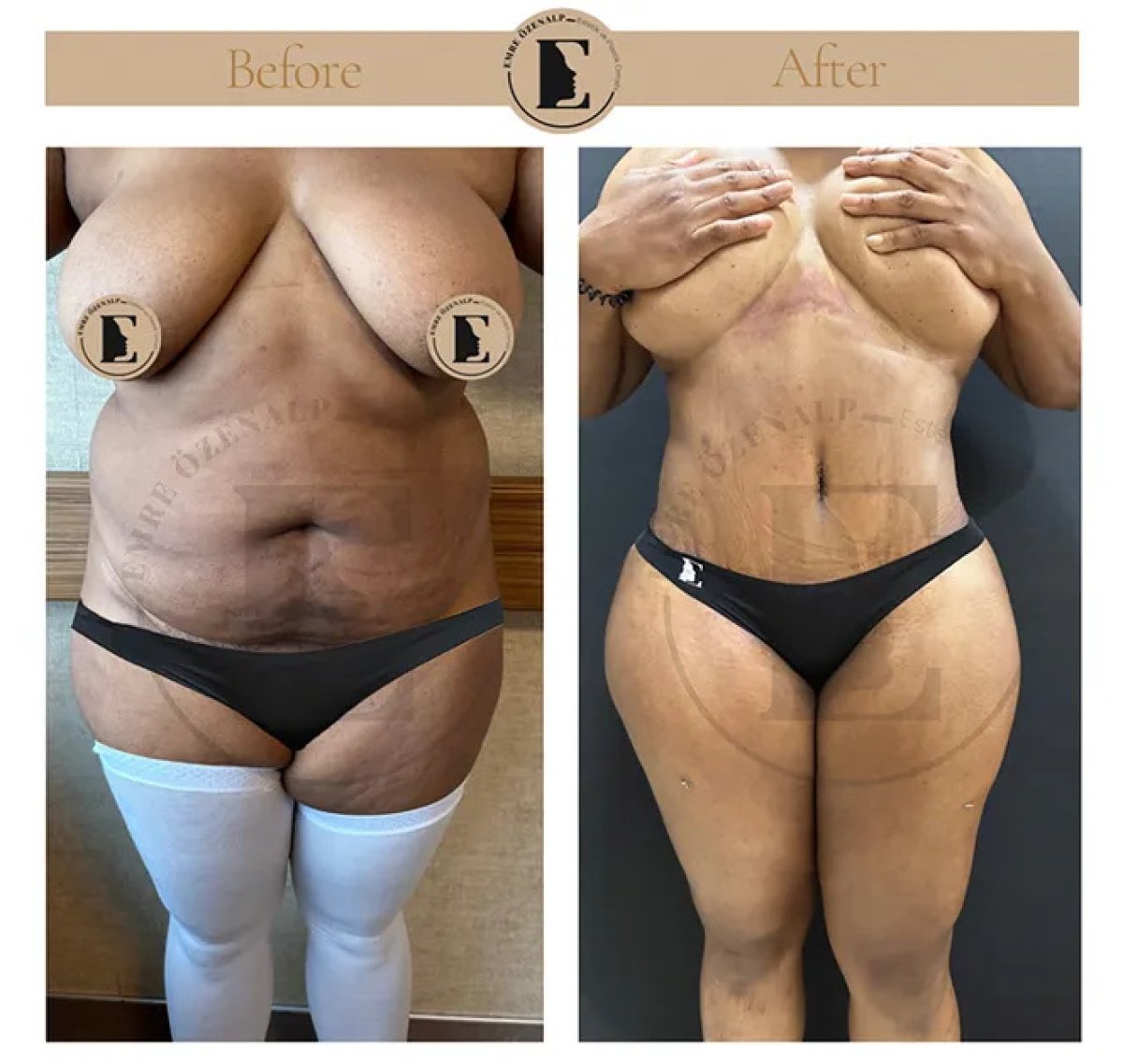 Before and after tummy tuck results at Emre Özenalp Clinic, visible abdominal contouring