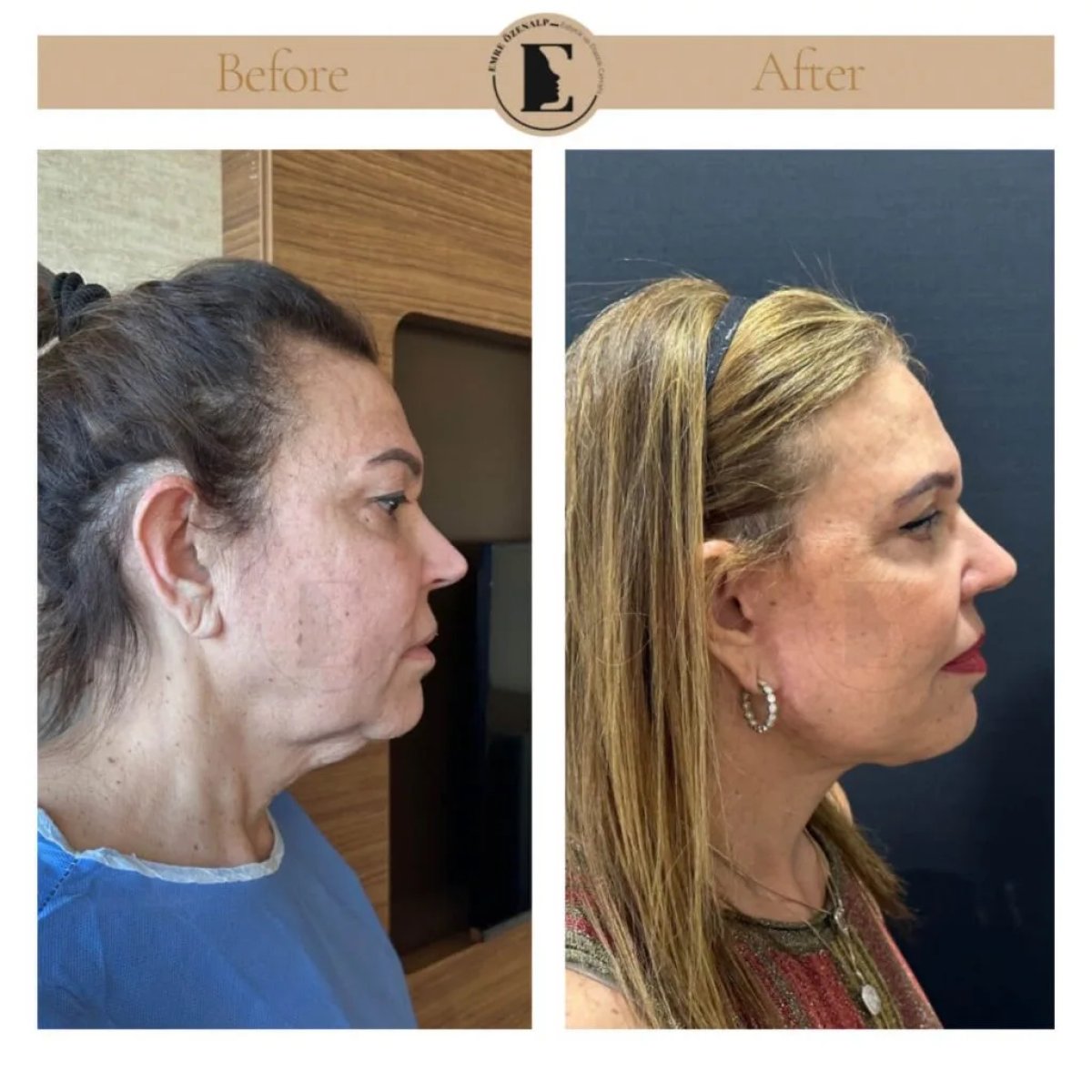 Before and after neck lift results at Emre Özenalp Clinic, visible jawline and neck contour