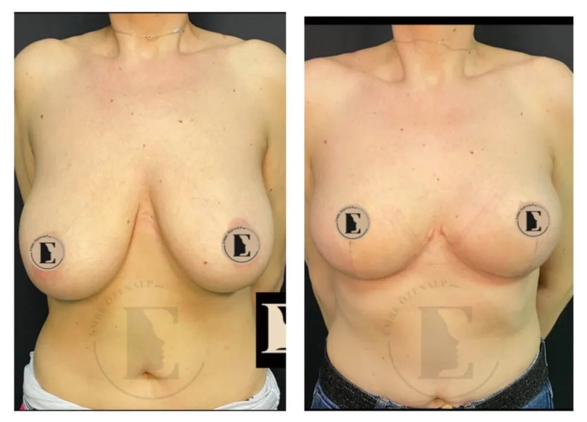Before and after breast lift results at Emre Özenalp Clinic, improved breast contour