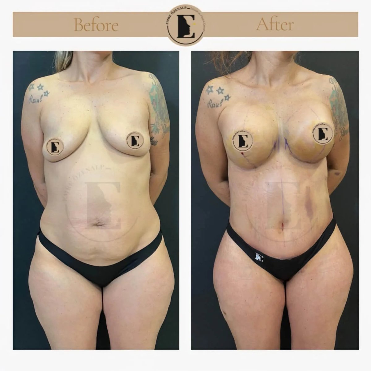 Before and after breast lift results at Emre Özenalp Clinic, visible breast contour improvement