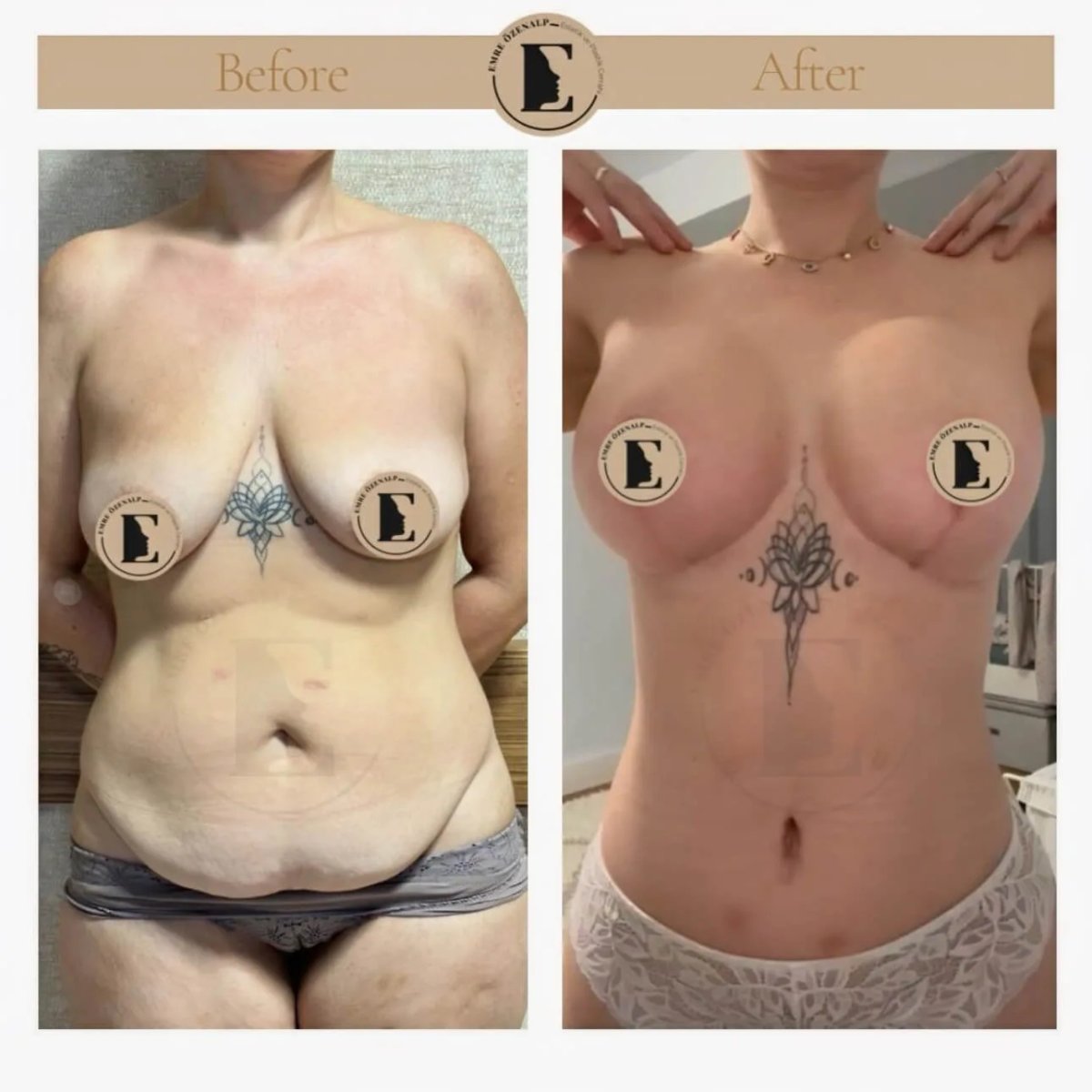 Результаты до и после абдоминопластики и липосакции в Emre Özenalp Clinic, коррекция тела