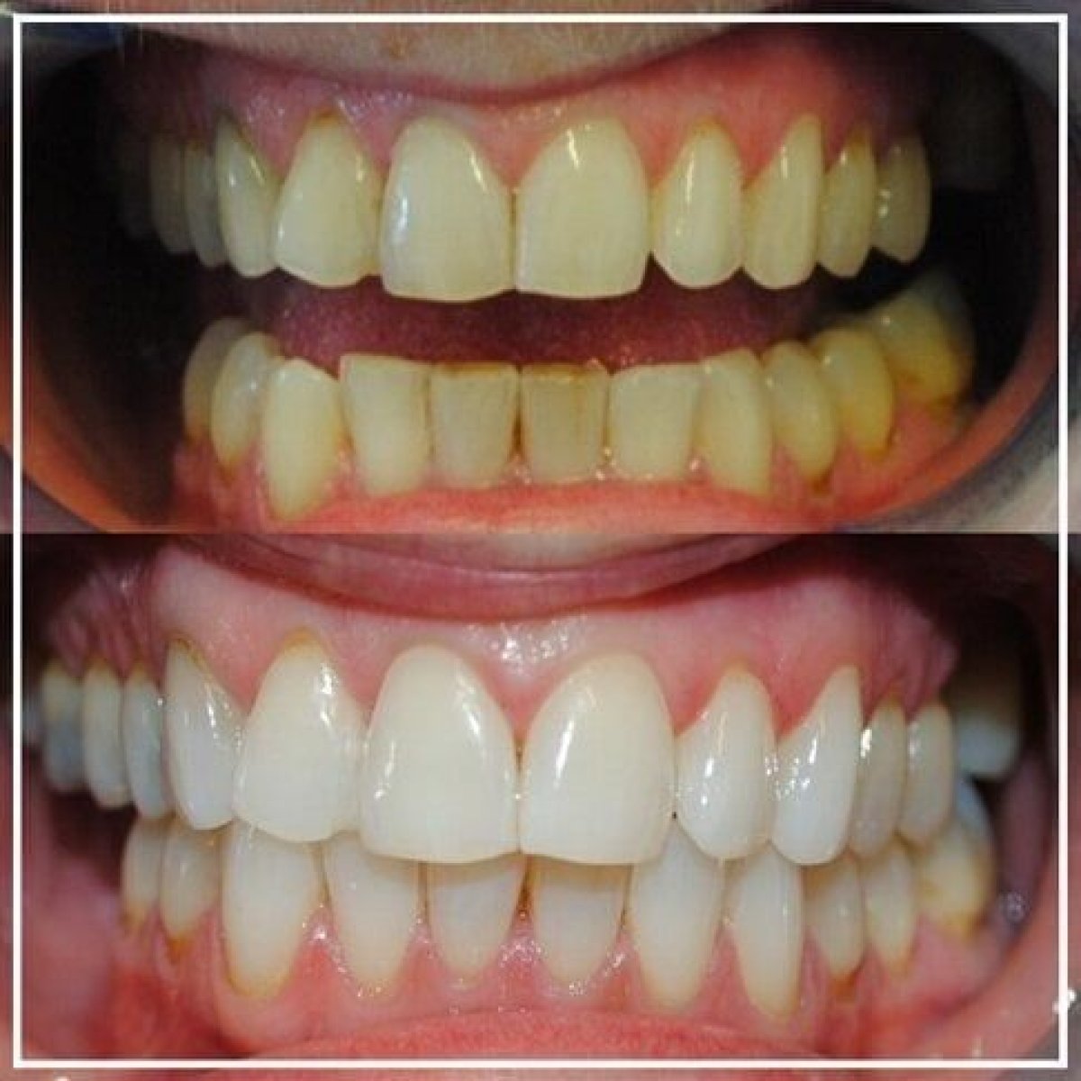 Résultats avant et après du blanchiment dentaire à SoftDentalCare Clinic – sourire plus éclatant