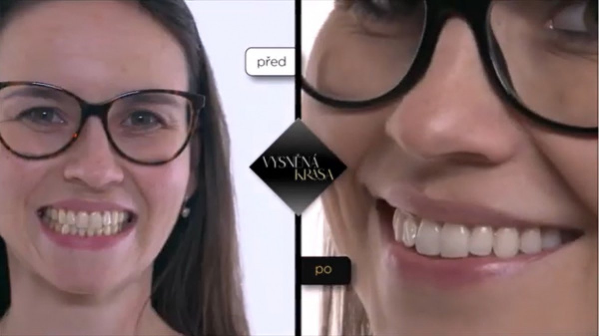 Результаты до и после отбеливания зубов в Schill Dental Clinic – заметно белее улыбка