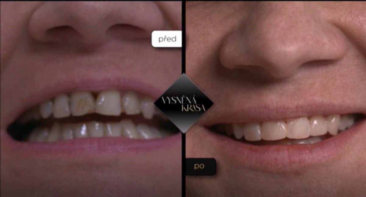 Результати до і після Invisalign у Schill Dental Clinic – рівні, білі зуби