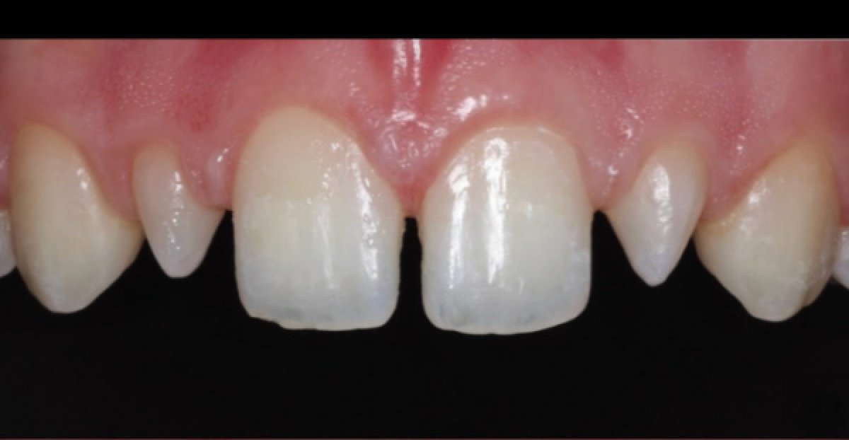 До встановлення вініров у Schill Dental Clinic – видимі щілини та нерівні передні зуби
