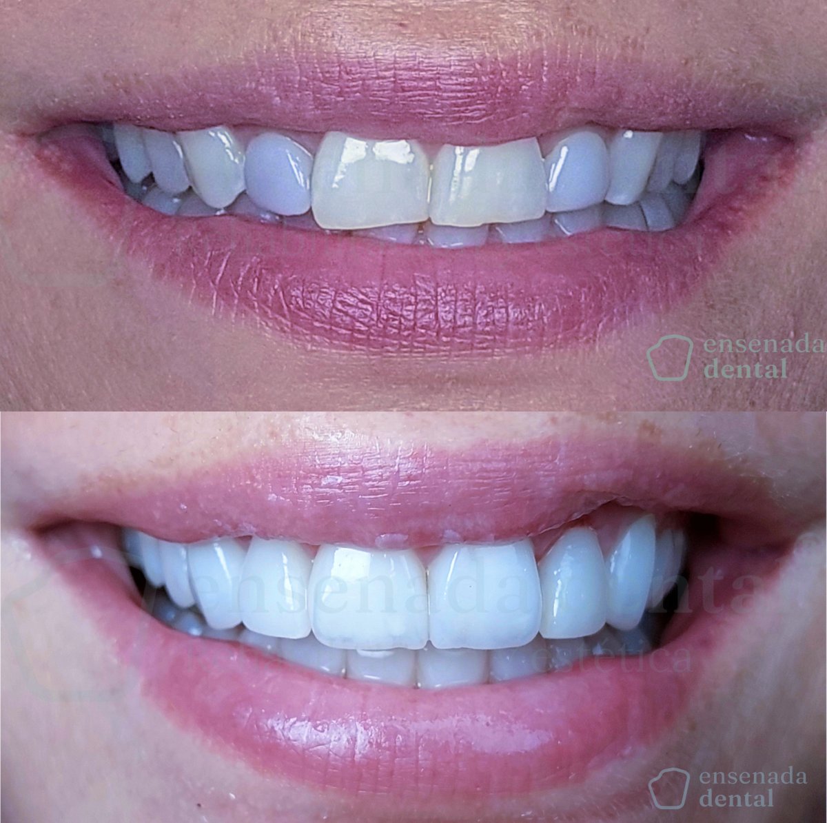 نتائج قبل وبعد الفينير في Ensenada Dental – تحول طبيعي للابتسامة