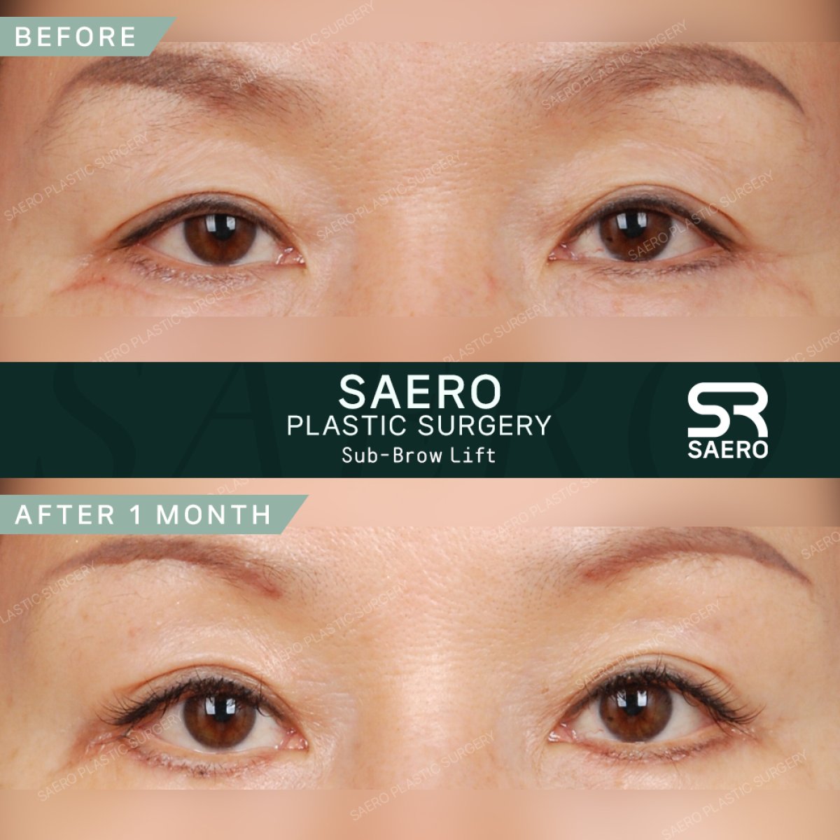 Resultados antes y después de sub-brow lift en SAERO Plastic Surgery, rejuvenecimiento de párpados