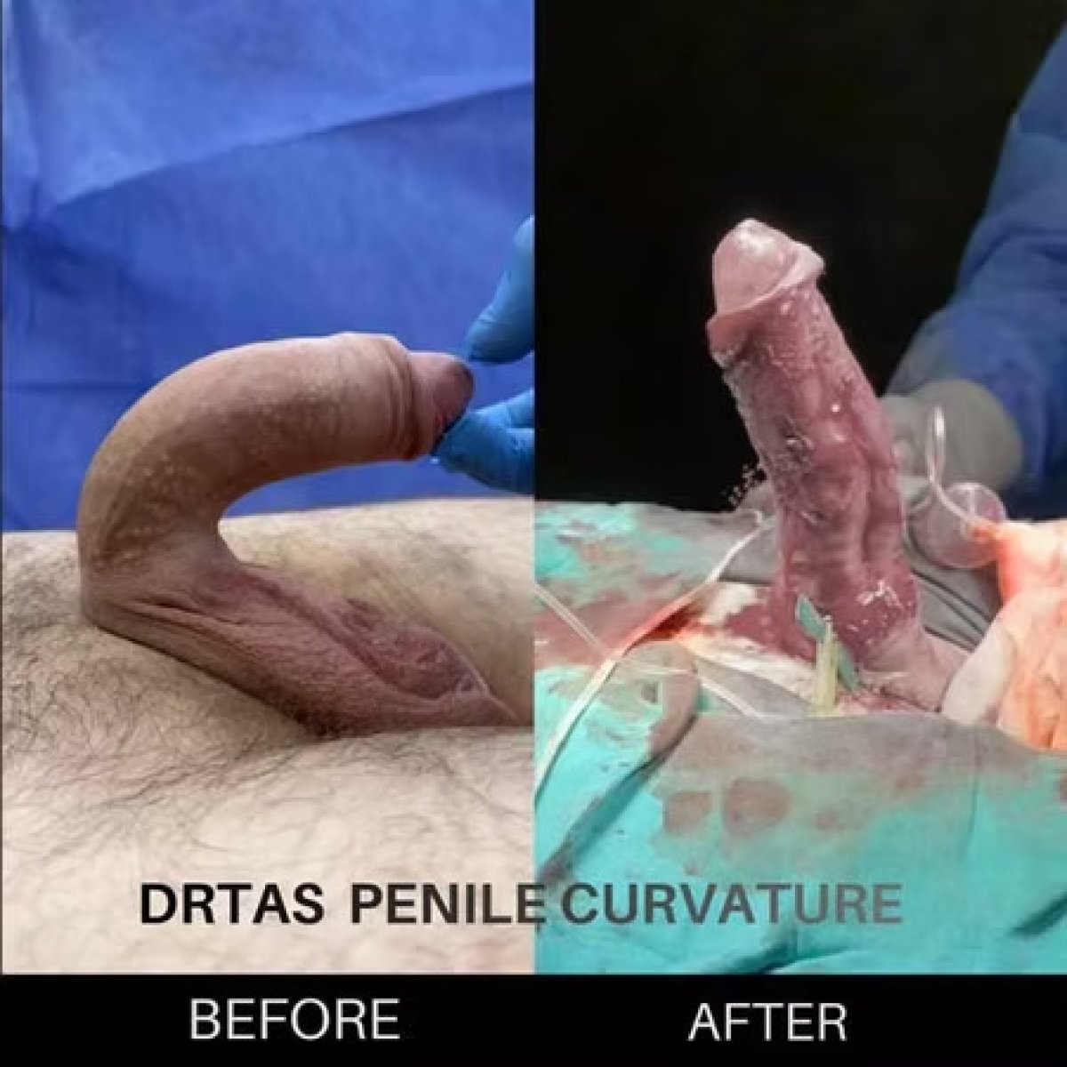 До та після корекції викривлення пеніса в Safe Urology – результат вирівнювання