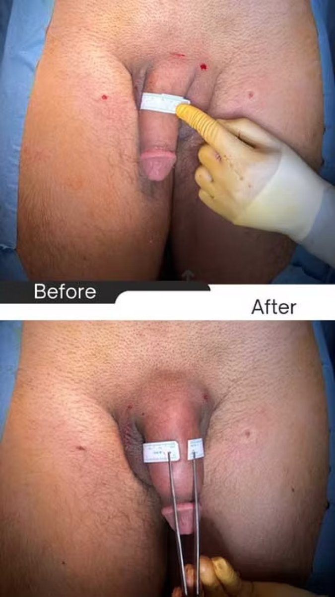Résultats avant/après chirurgie de réattribution sexuelle chez Safe Urology – reconstruction génitale