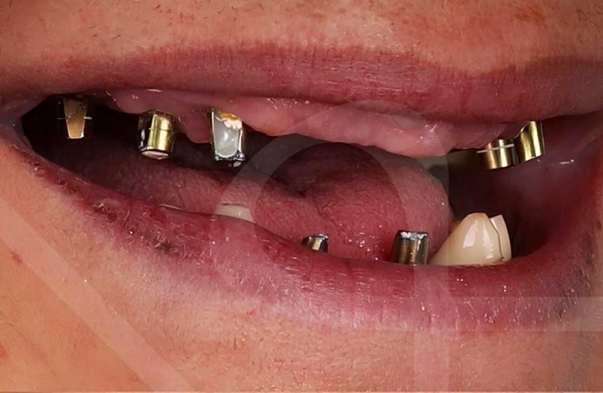 Dental crown installation process at Vialife Clinic, visible abutments before final crowns