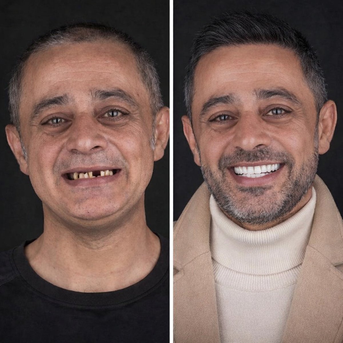 Before and after Hollywood Smile results at Vialife Clinic – complete smile transformation