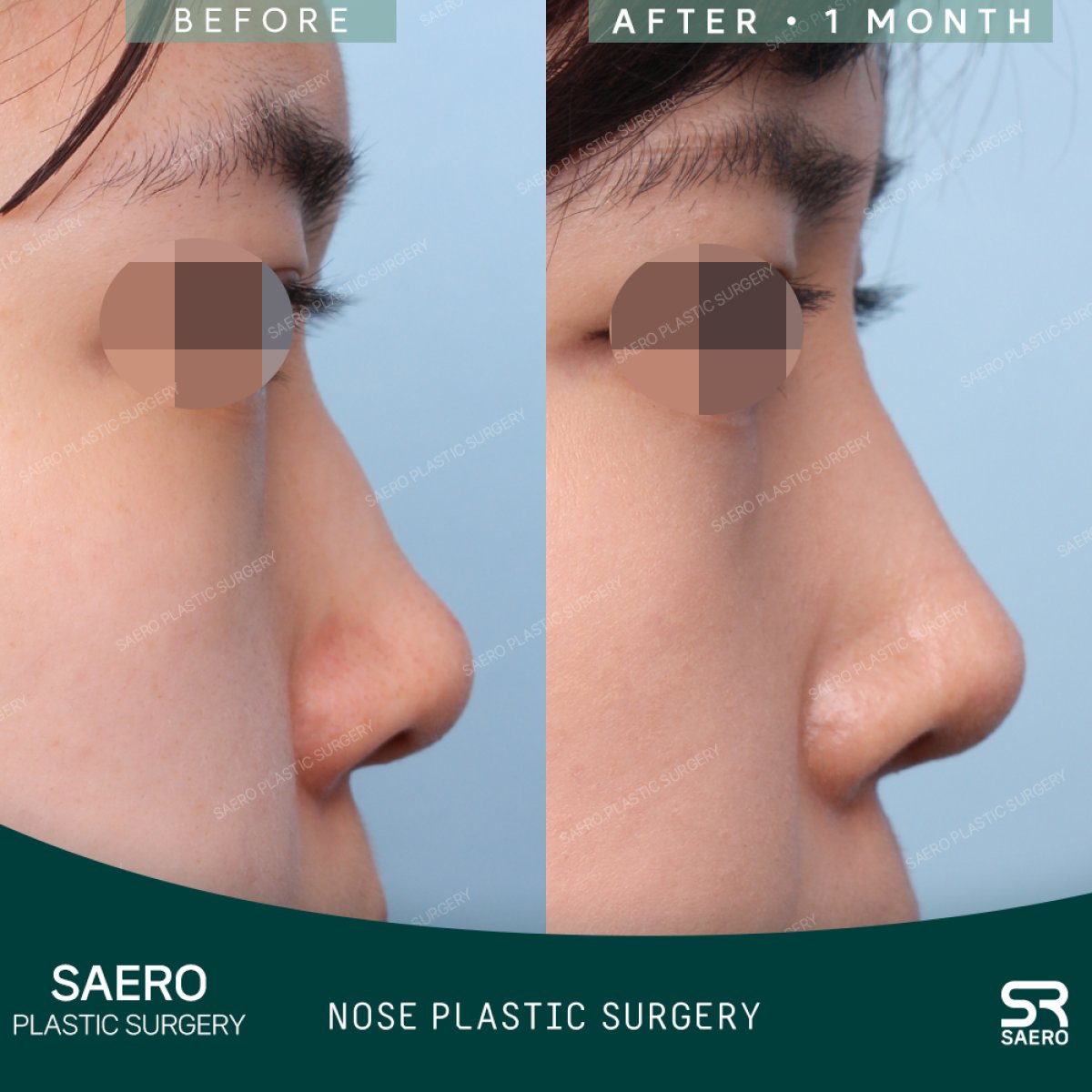 Before and after rhinoplasty results at SAERO Plastic Surgery, improved nose profile after 1 month