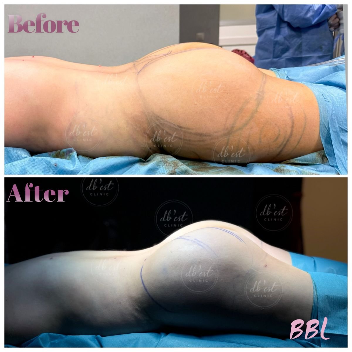 نتائج قبل وبعد عملية Brazilian Butt Lift في Db'est Clinic – تحسين شكل الأرداف