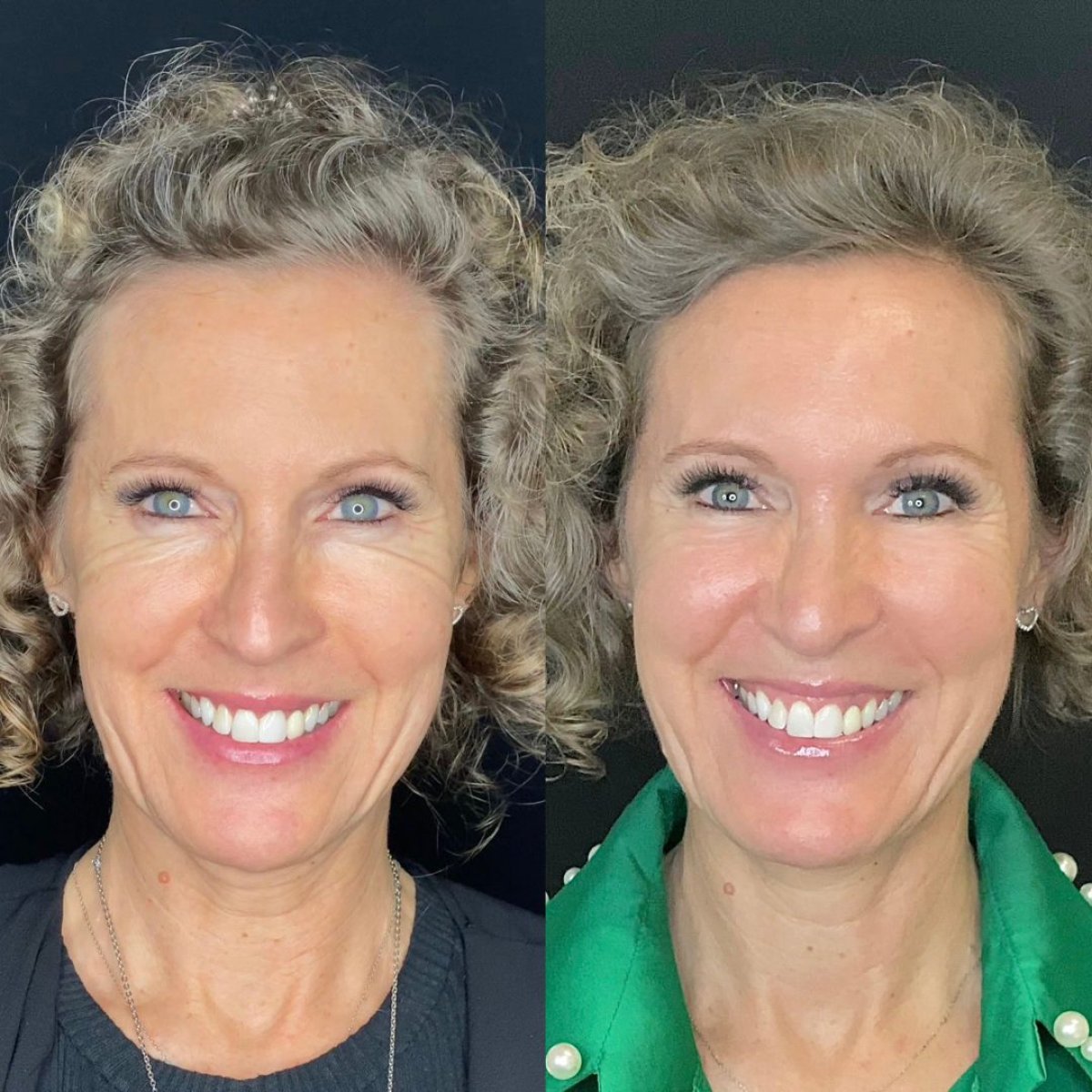Vorher-nachher-Ergebnis Facelift bei MyMoment, sichtbare Verjüngung und glattere Haut
