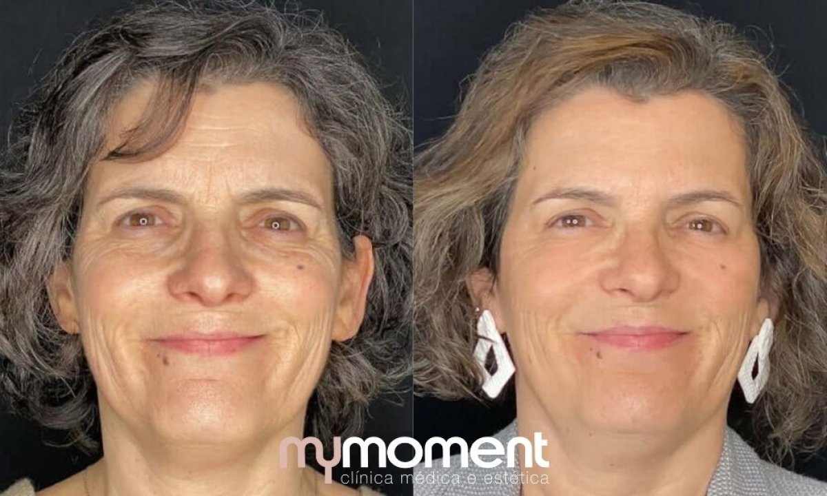 Vorher-nachher-Ergebnis Facelift bei MyMoment, sichtbare Verjüngung und Straffung