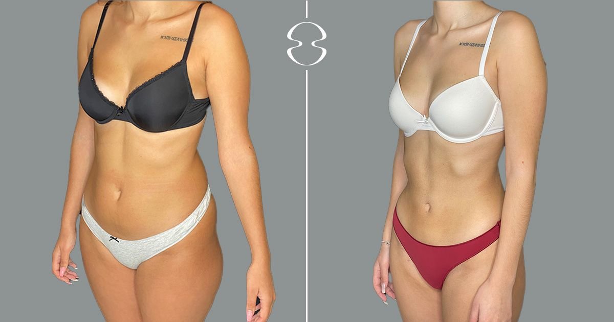 Before and after liposuction results at MyMoment – visible body contouring improvement