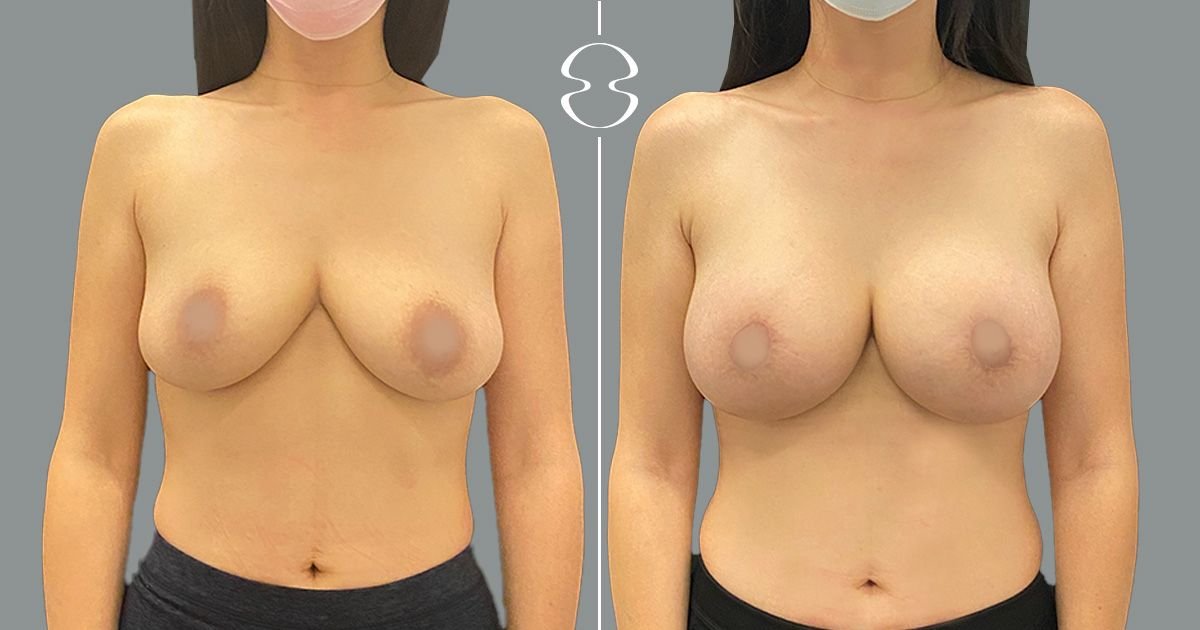 Resultados de lifting de senos antes y después en MyMoment – mejor forma y contorno
