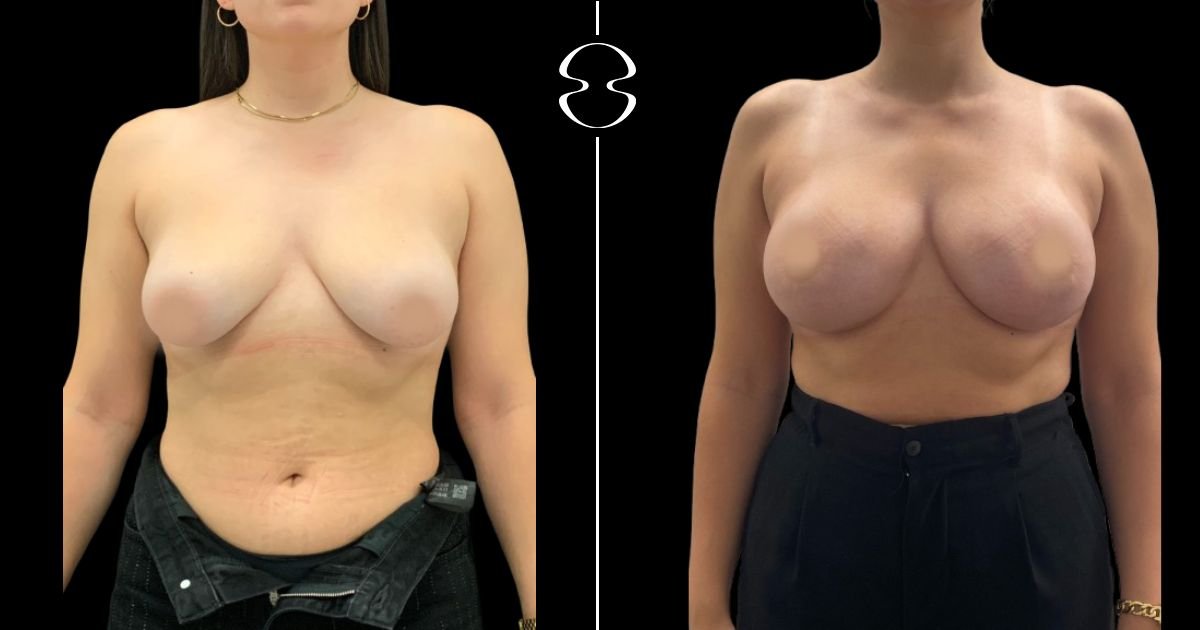 Before and after breast lift results at MyMoment clinic – improved breast shape and contour