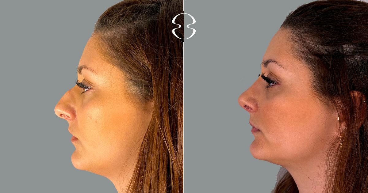 Resultados de rinoplastia antes y después en MyMoment, perfil nasal mejorado de forma natural
