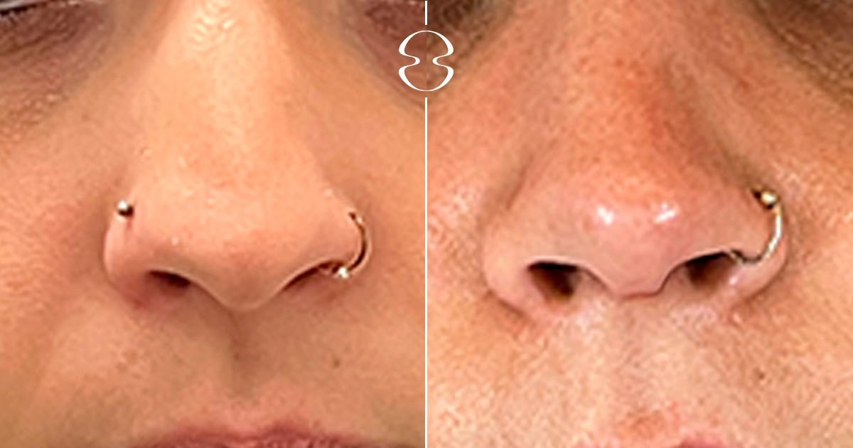 Resultados de rinoplastia antes y después en MyMoment, remodelación nasal y simetría mejorada