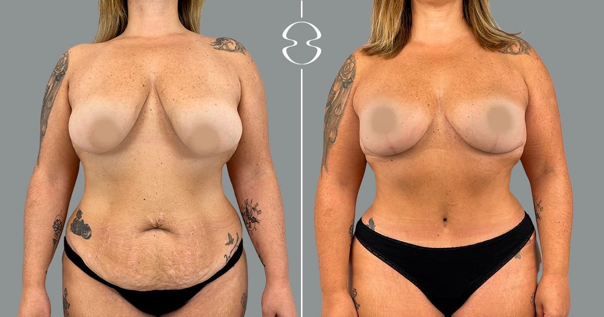Before and after tummy tuck results at MyMoment – visible abdominal contour improvement