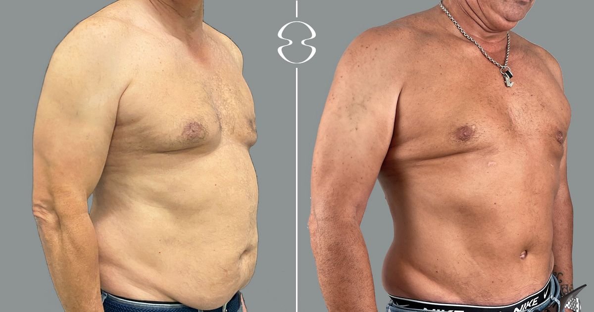 Before and after gynecomastia surgery results at MyMoment – flatter male chest contour