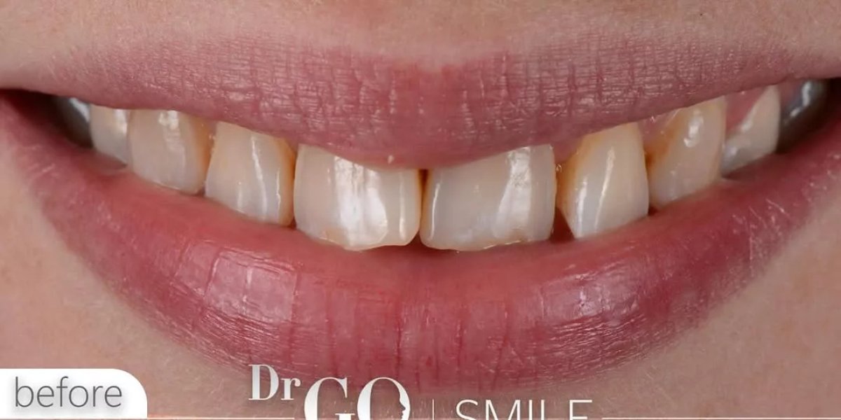 Before tooth whitening at DrGO Smile Clinic, visible yellowish teeth before procedure