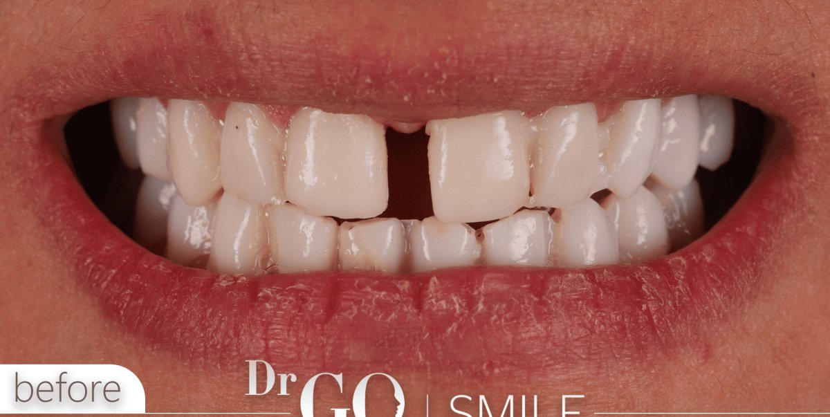 Before braces treatment at DrGO Smile Clinic, visible teeth gaps and misalignment shown